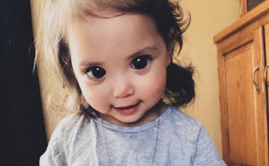 Căn bệnh khiến đôi mắt của em bé hai tuổi trở nên to tròn