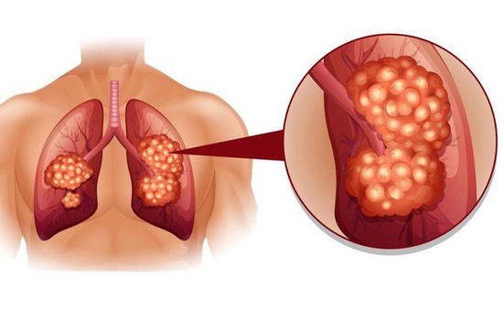 Tầm soát sớm tăng khả năng điều trị ung thư phổi