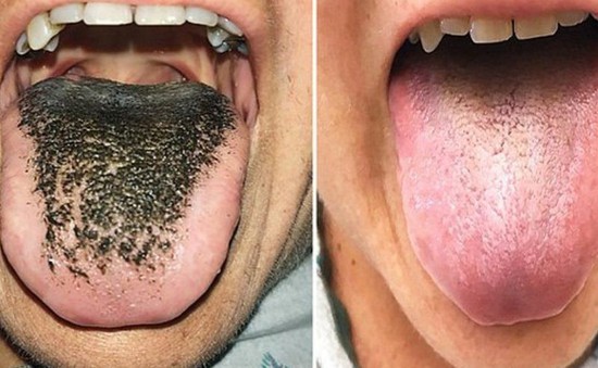 Lông mọc trong lưỡi - Căn bệnh cực hiếm do dùng kháng sinh