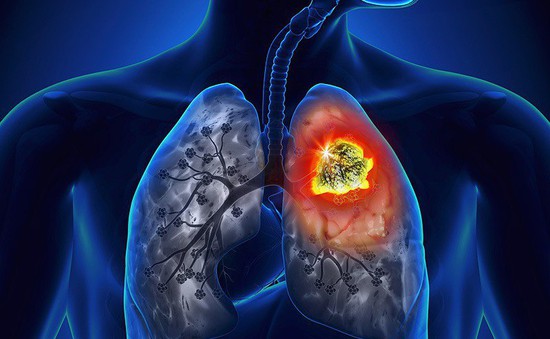 Ung thư phổi giai đoạn sớm, các yếu tố nguy cơ không thể bỏ qua
