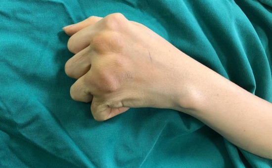 Giúp đôi tay hoạt động trở lại sau 10 năm bị viêm khớp dạng thấp