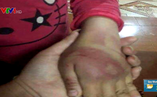 Bé gái 8 tuổi ở Thanh Hóa nghi bị bố đẻ bạo hành