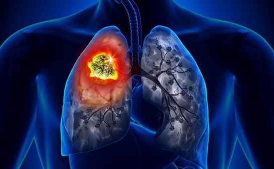 Hệ thống AI giúp phát hiện sớm ung thư phổi