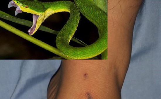 Nhận biết rắn độc - Xử trí sơ cứu khi bị rắn cắn