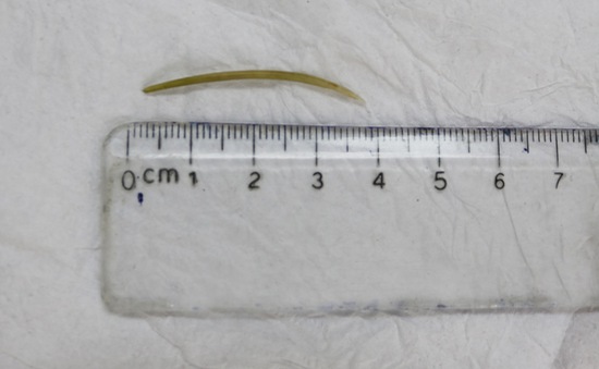 Nuốt xương cá dài 4cm khi ăn lẩu gây thủng ruột non