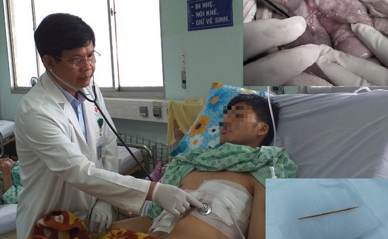 Nuốt tăm lúc ngủ, nam thanh niên phải cầu cứu bác sĩ vì tăm đâm vào màng tim