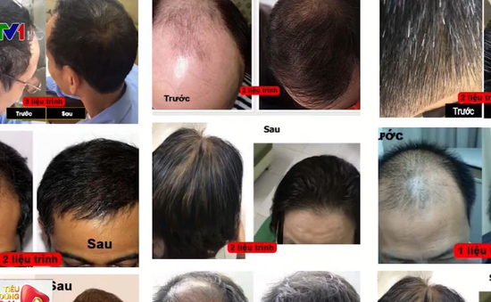 Top 7 thuốc mọc tóc tốt nhất được các chuyên gia khuyên dùng