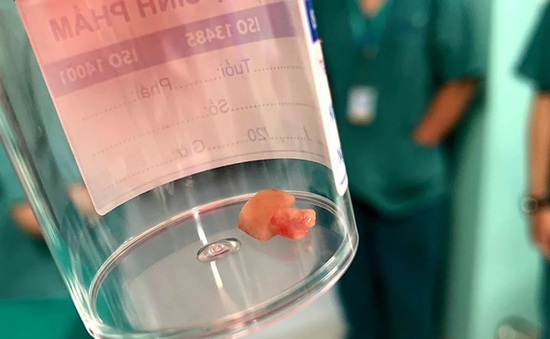 Hạt đậu phộng "cư trú" 2 tháng trong phổi bé gái, gây nhầm tưởng là hen suyễn