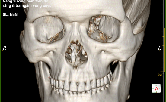 Vào viện phát hiện răng ngầm xương hàm chọc thủng hốc mũi, phá hủy xương hàm