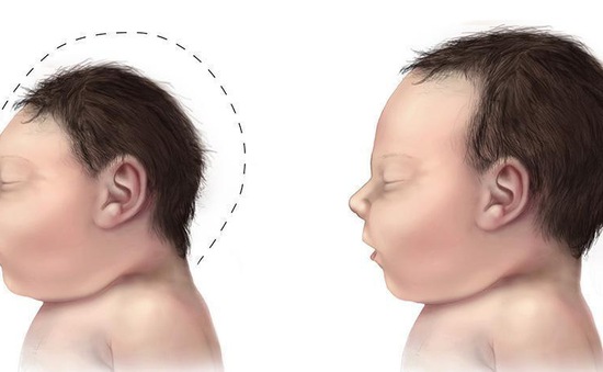 Nguyên nhân gây tật đầu nhỏ ở trẻ sơ sinh?