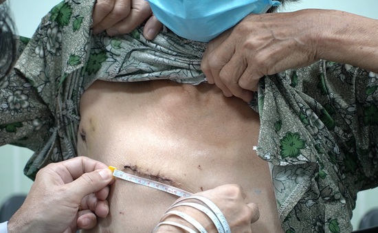 Lần đầu tiên tại Việt Nam: Áp dụng kỹ thuật phẫu thuật tim xâm lấn tối thiểu