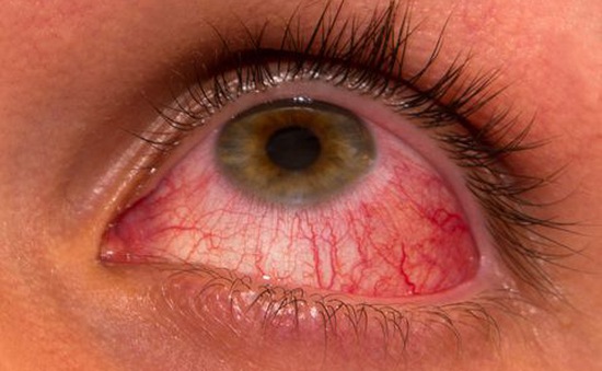 Lưu ý dấu hiệu bệnh lý viêm màng bồ đào ở mắt