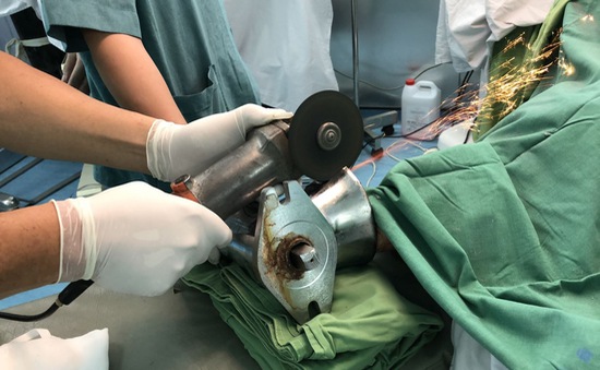 VIDEO: Phẫu thuật thành công cho bệnh nhân dập nát cánh tay do bị cuốn vào máy xay thịt
