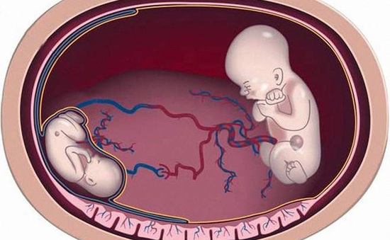 Truyền máu song thai - Bệnh hiếm cần tầm soát khi mang song thai