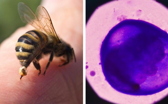 Nọc ong mật có thể tiêu diệt tế bào ung thư vú ác tính