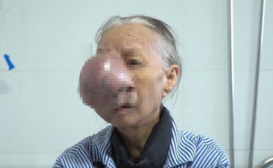 Cắt bỏ khối u lớn trên mặt cho bệnh nhân 74 tuổi