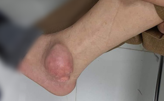 Khối u to như quả ổi "mọc" ở chân sau khi chữa gout bằng thuốc đông y