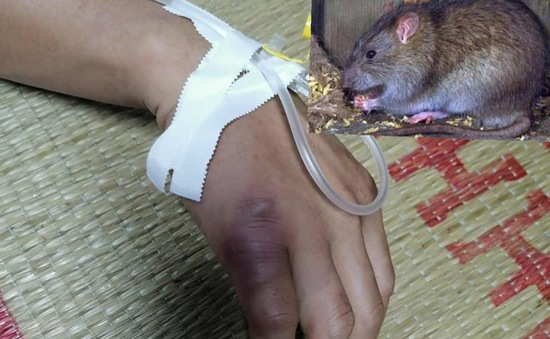 Nghi mắc dịch hạch sau khi bị chuột cắn vào tay