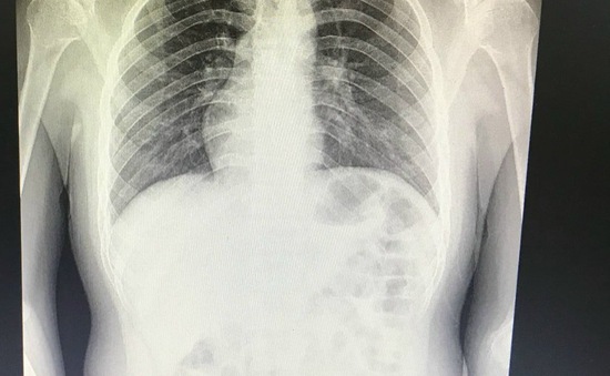 Mổ ruột thừa, nam thanh niên phát hiện tim nằm... bên phải