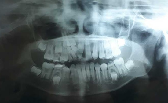 Trẻ chậm mọc răng do răng thừa ngầm