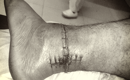 Nối thành công cẳng chân bị đứt lìa do máy cắt cỏ cho bệnh nhân