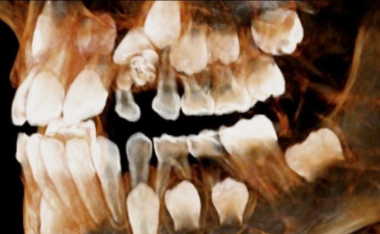 U răng - một trong những nguyên nhân gây ra thiếu răng trên cung hàm