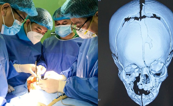 Phẫu thuật tạo hình cho bé sơ sinh 17 ngày tuổi có khe hở sọ mặt phức tạp rất hiếm gặp