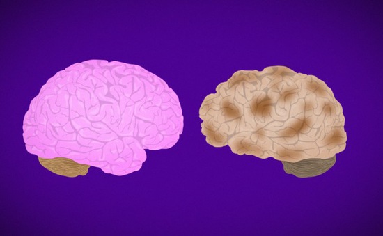 Người ngoài 30 tuổi cần ngăn ngừa bệnh Alzheimer khi có những dấu hiệu cảnh báo này