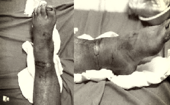 Vi phẫu nối bàn chân bị đứt lìa cho nam bệnh nhân 47 tuổi