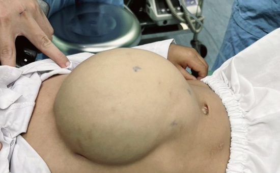 Phẫu thuật thoát vị thành bụng lớn kèm dị tật ruột xoay dở dang cho bé trai người Lào