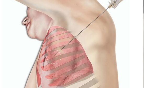 Sinh thiết phổi xuyên thành ngực có rủi ro hay không?