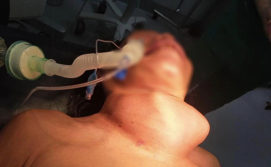 Cắt khối bướu giáp nặng 2kg chèn ép khí quản bệnh nhân