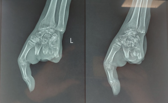 Chuyển ngón chân thành ngón tay cho bệnh nhân bị máy xay thịt cuốn nát