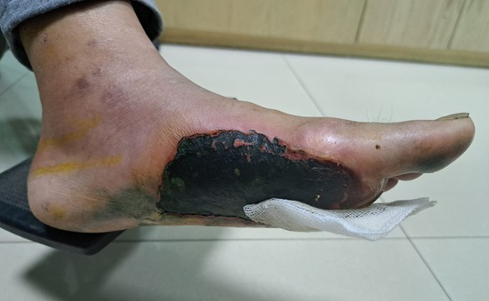 Cảnh báo: Hoại tử, loét bàn chân do sử dụng túi chườm nóng ở bệnh nhân đái tháo đường
