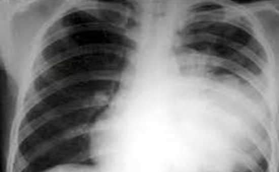 Bệnh viêm thùy phổi ở trẻ em biến chứng nguy hiểm khó lường