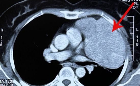 Đi mổ ruột thừa, bệnh nhân phát hiện khối u chèn ép phổi