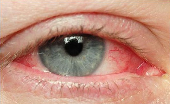 Bệnh đau mắt đỏ lây lan: Việc cần làm và việc cần tránh