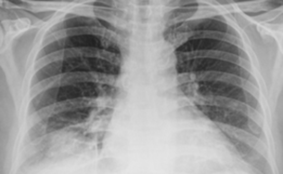 Gây dính màng phổi bằng bột talc điều trị tràn dịch màng phổi tái diễn cho người bệnh
