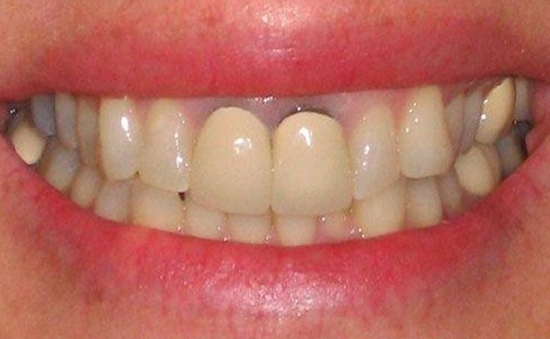 Ánh đen răng, lợi không ôm sát chân răng khi trồng implant báo hiệu điều gì?