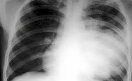 Cảnh báo gia tăng viêm phổi do vi khuẩn Mycoplasma ở trẻ nhỏ
