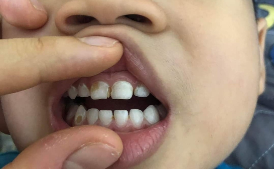 TP. Hồ Chí Minh: Thí điểm mô hình trường - trạm chăm sóc sức khoẻ răng miệng học sinh