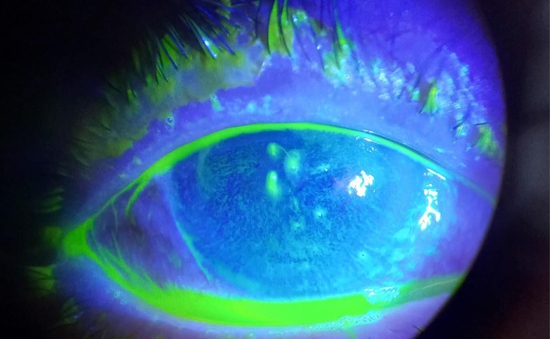 Côn trùng bay vào mắt: Mối nguy hiểm không thể coi thường