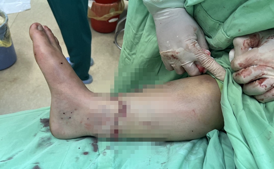 Nối bàn chân bị đứt rời cho bệnh nhân tai nạn giao thông
