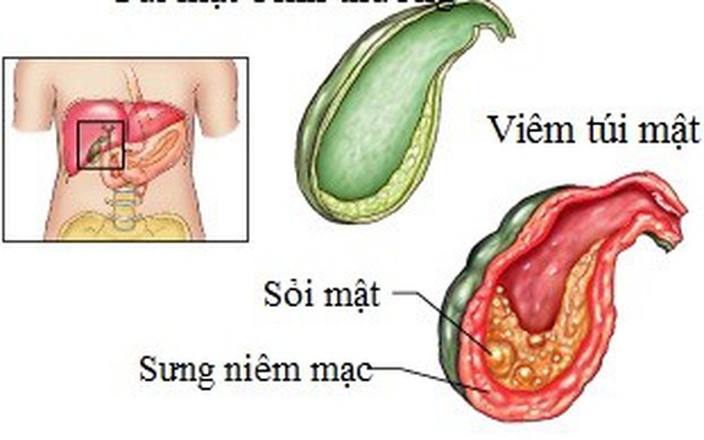 Phòng ngừa viêm túi mật mãn tính như thế nào?
