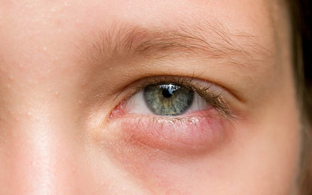 Làm sao để phòng ngừa sưng đỏ vùng da quanh mắt?
