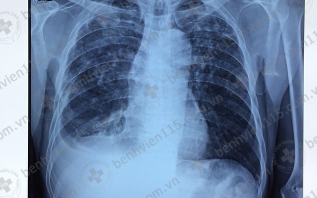 Bùng phát lao phổi trên bệnh nhân suy nhược cơ thể | VTV.VN