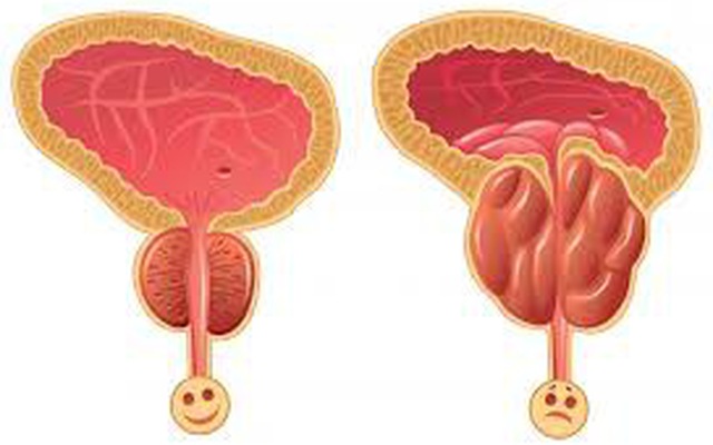 Phì đại tuyến tiền liệt ở nam giới do đâu? | VTV.VN