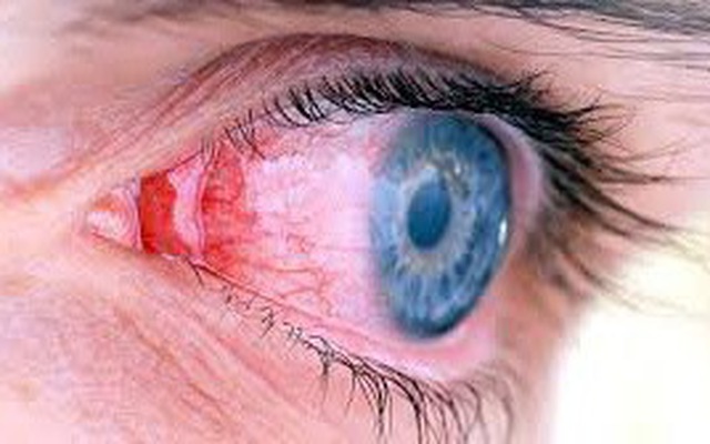 Cách chăm sóc phác đồ điều trị viêm màng bồ đào để giảm nguy cơ việc mắt bị tổn thương