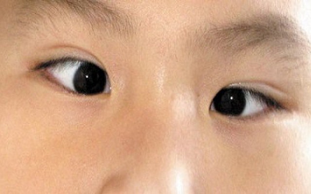 Mắt lé - bệnh về mắt gây giảm thị lực, thẩm mỹ | VTV.VN