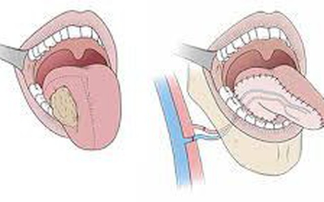 Dấu hiệu ung thư lưỡi mà bạn dễ dàng bỏ qua | VTV.VN